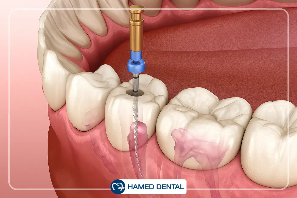 درمان ریشه دندان
