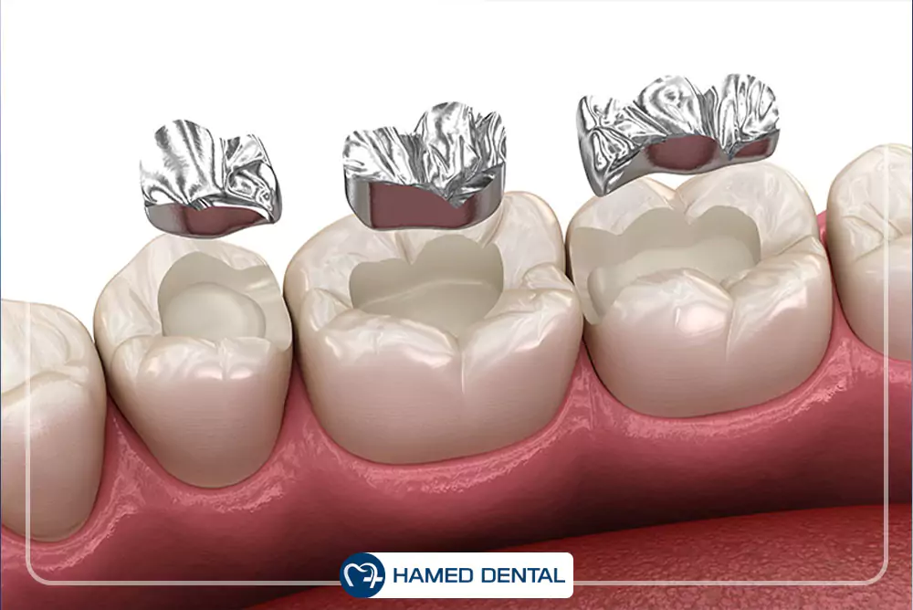 آمالگام و آمالکپ دندانپزشکی