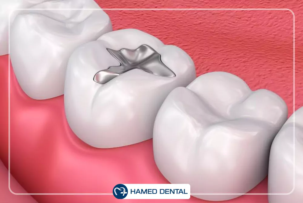 آمالگام و آمالکپ دندانپزشکی