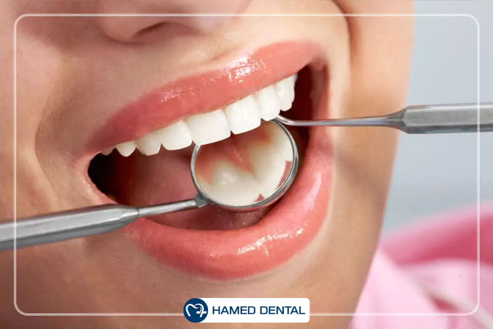 کامپوزیت دندانپزشکی