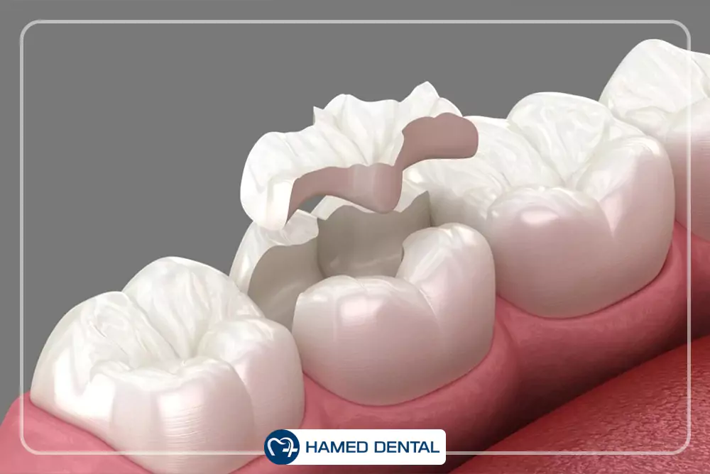 بیس و لاینر