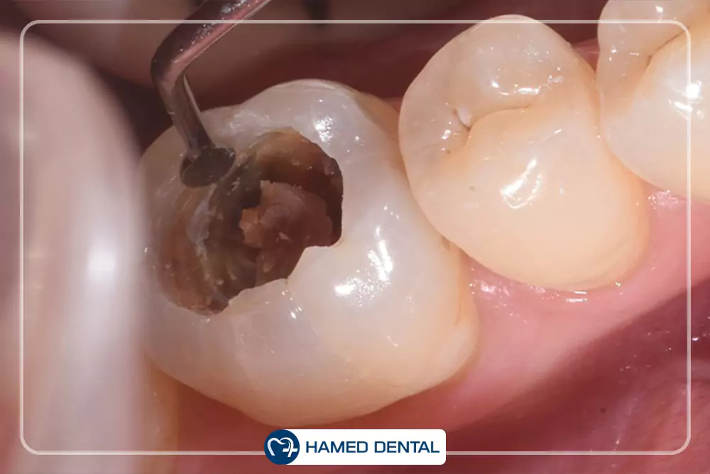 بیس و لاینر